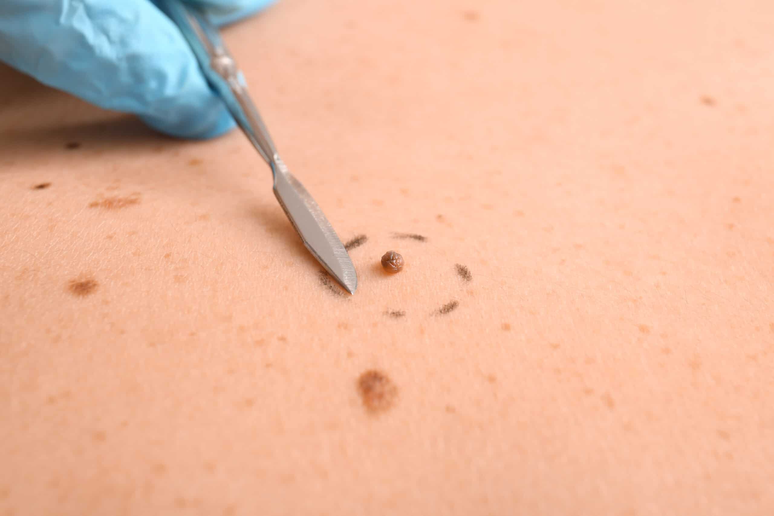 Nevus, Skin Tags Removal - Indo Taj Medical Center